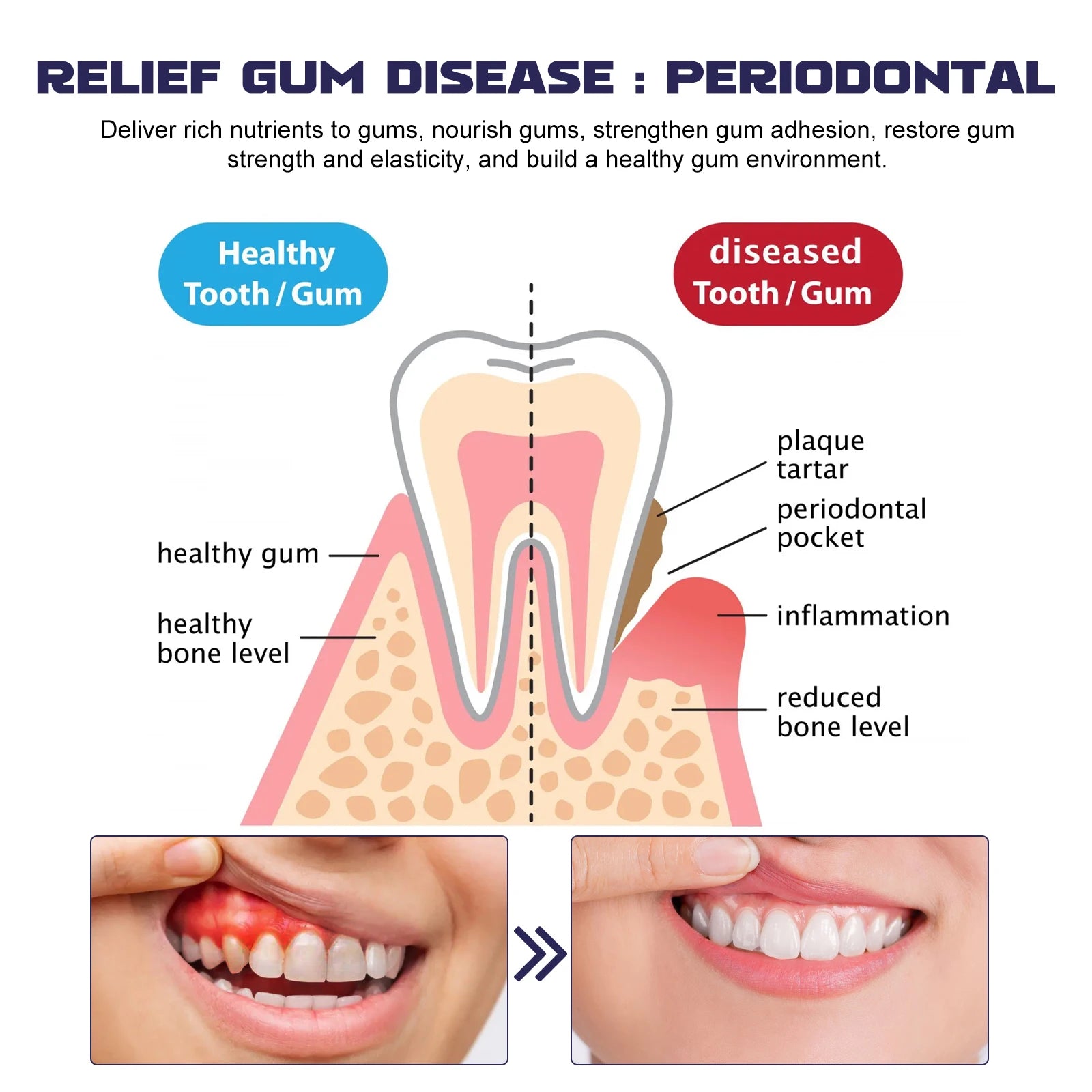 Ouhoe V34 Professional Teeth Whitening And Repair Gel Breaks Down The Stains On The Tooth Surface To Achieve Highly Efficient