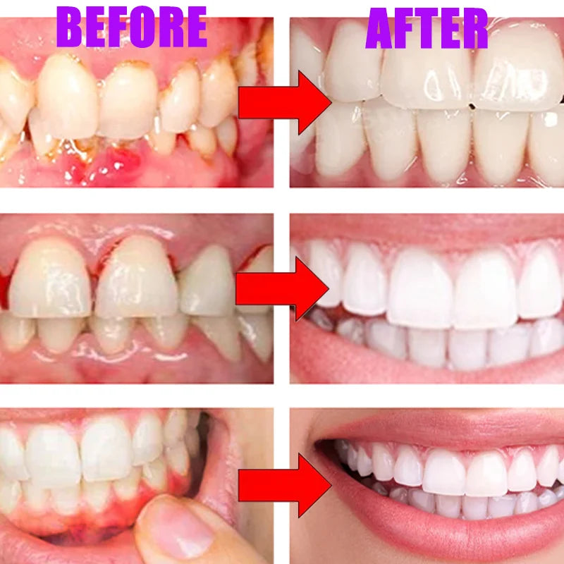 Ouhoe V34 Professional Teeth Whitening And Repair Gel Breaks Down The Stains On The Tooth Surface To Achieve Highly Efficient